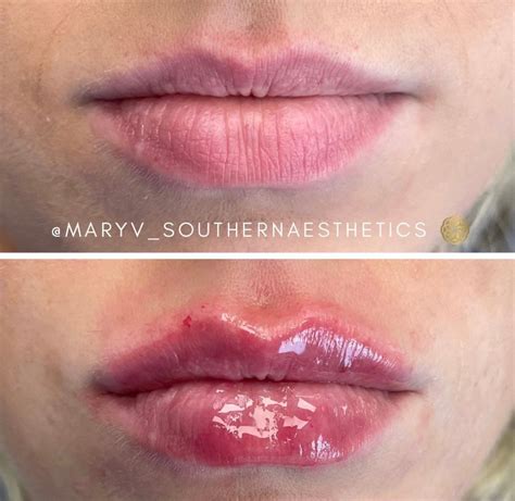 have you ever seen more perfect lips? 😍⁠ ⁠ | Lip fillers, Perfect lips ...