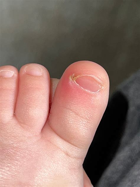 infected ingrown toenail | BabyCenter