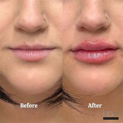 How To Give Lip Fillers at Andres Lowe blog