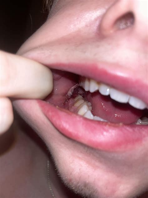 Hanging Blood Clot From Wisdom Tooth Extraction : r/askdentists
