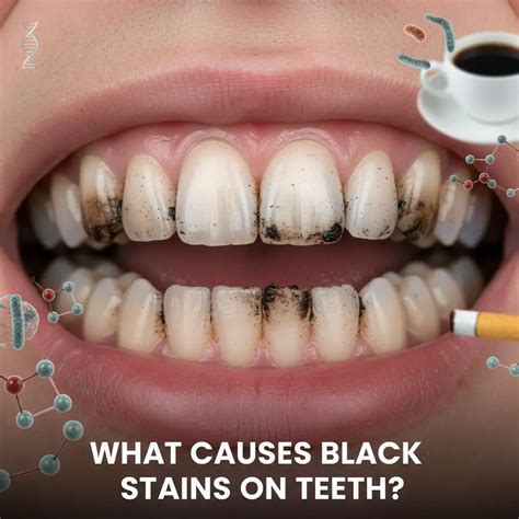 How to Get Rid of Black Stains on Teeth? Try These Expert Tips - SNOW ...