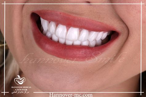 Replace Your Missing Teeth - Full Mouth Dental Veneers - Hannover Medical Center Sharjah