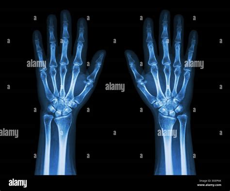 X Ray Normal Hand High Resolution Stock Photography and Images - Alamy
