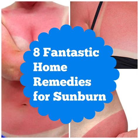 8 Fantastic Home Remedies For Sunburn - Corinna B's World