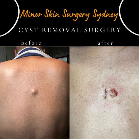 Sebaceous Cyst Removal Scar Skin Cyst Treatment And Removal | Saguaro