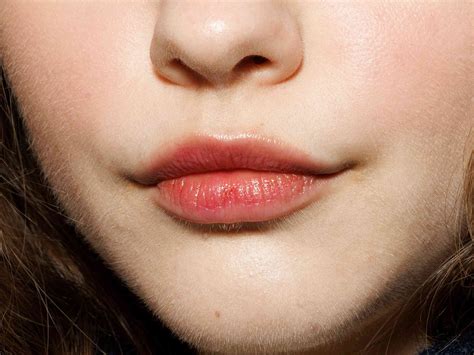 Cold Sore vs. Lip Pimple and How to Tell the Difference