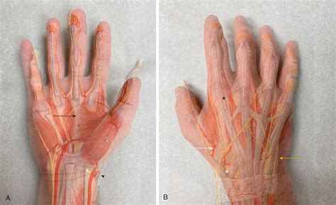 Metacarpal Fractures - Clinical Tree
