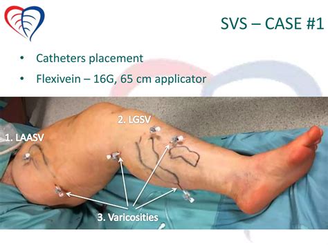 Potential advantages of steam ablation of varicose veins | PPTX