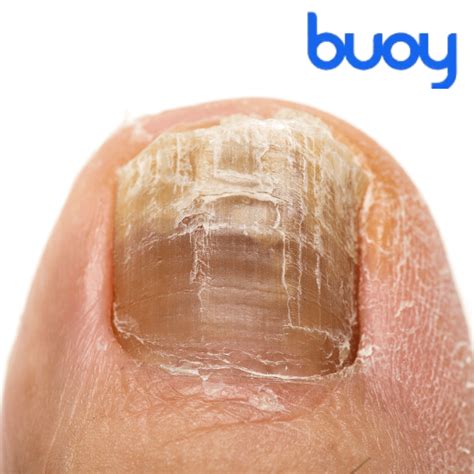 Why is my toenail turning black | Buoy Health : u/buoyhealth