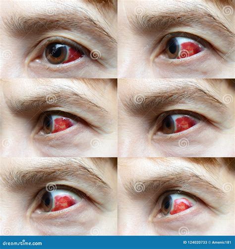 Woman with Burst Blood Vessel in Eye Stock Image - Image of health ...