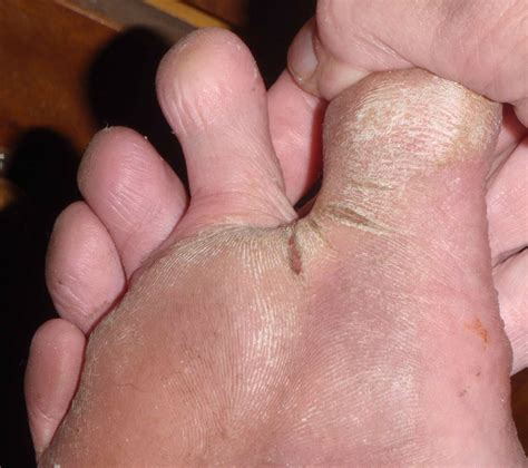 Sole Of Foot Cracking