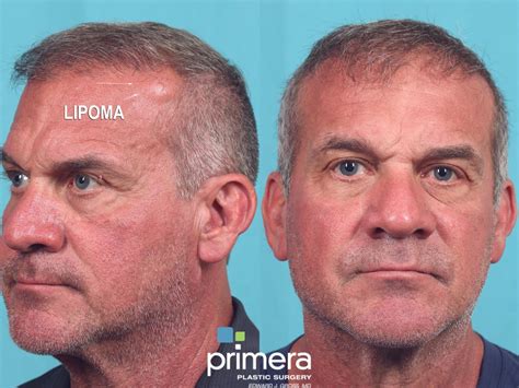 Cyst Removal Before and After Pictures Case 895 | Orlando, Winter Park ...