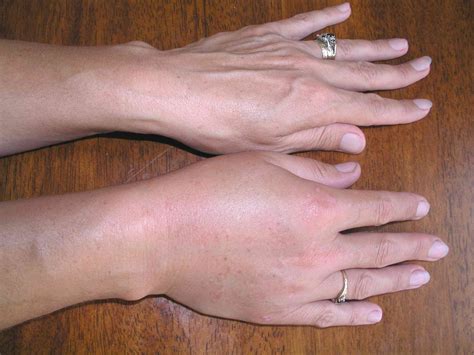 Angioedema Hands