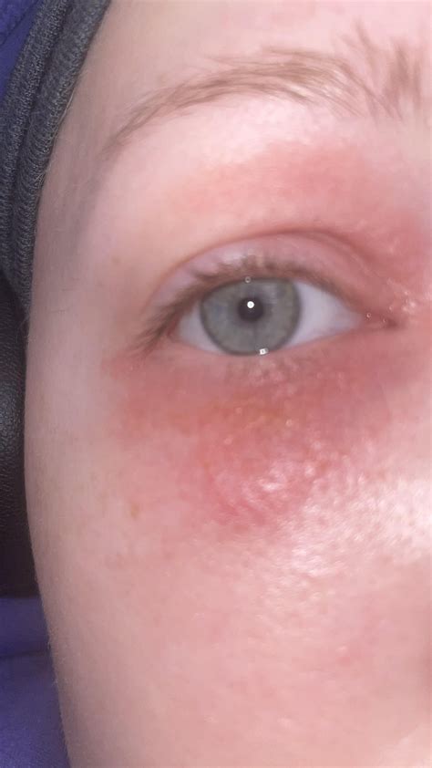 Recurring rashes and swelling on face and fingers for months. No creams ...