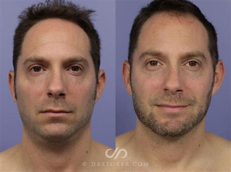 Dermal Fillers Los Angeles & Maria Del Rey | JUVEDERM, Restylane, & More | Stoker Aesthetics
