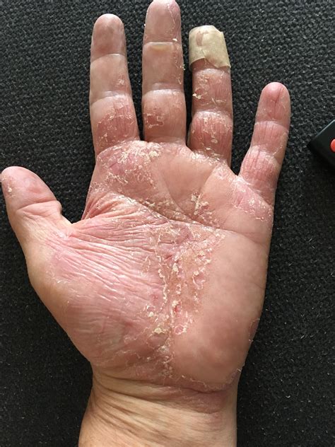 This is my eczema. This is actually the healing stage after a few weeks ...