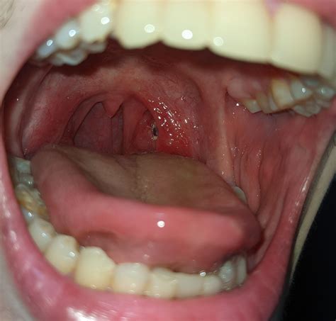 Popcorn Hull Stuck In Tonsil at John Heidt blog