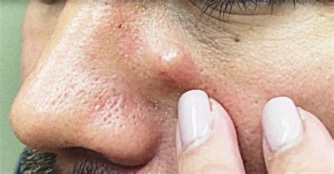 Best Dr Pimple Popper Cyst Videos All Fans Must Watch