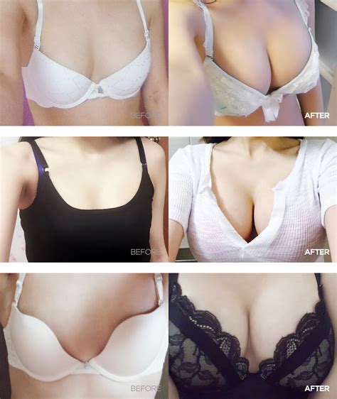 Breast Augmentation - Motiva - GRAND PLASTIC SURGERY
