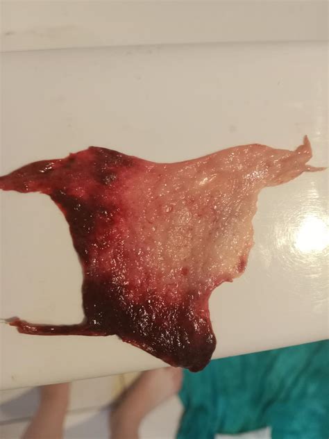 Decidual cast : r/MedicalGore