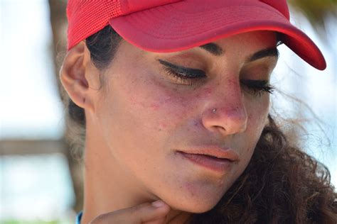 Best Treatment For Burn Scars On Face at Annabelle Wang blog