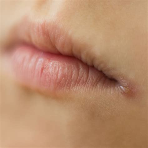 Angular Stomatitis Vs Cold Sore
