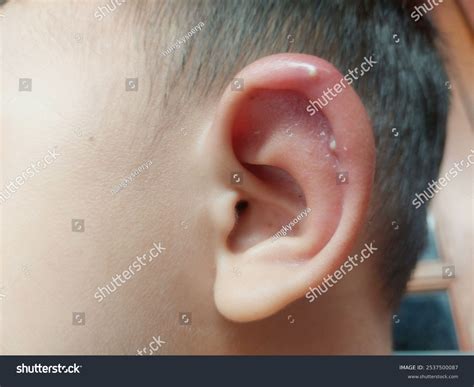Boils Furunkel Hidradenitis Suppurativa Hs Growing Stock Photo ...