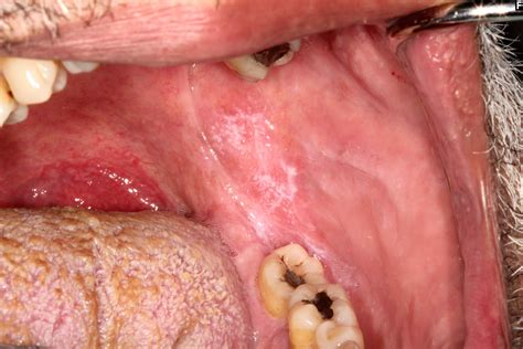 Is Oral Lichen Planus Painful at Lauren Harris blog