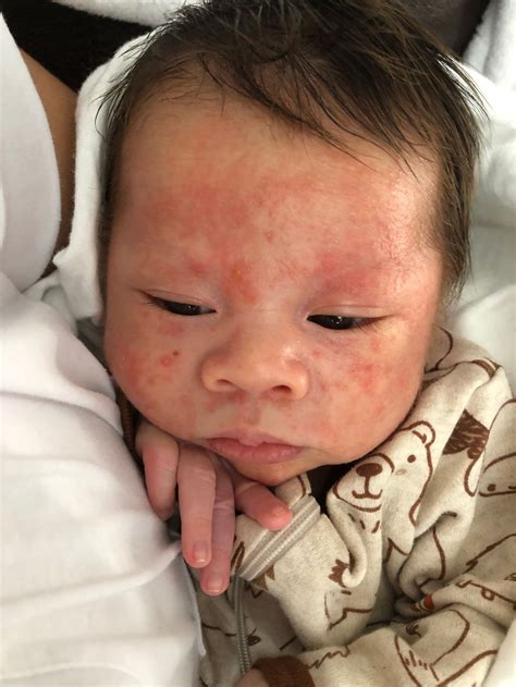 Seborrheic Dermatitis Infant