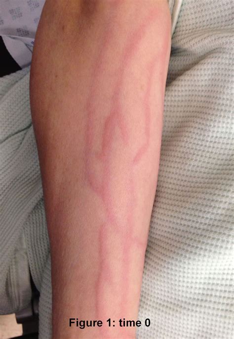 Iv Complications Phlebitis