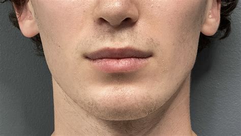 male face reshaping front 2 Dr Barry Eppley - Explore Plastic Surgery