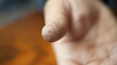 Fingertip Skin Hardening And Cracking at Ryan Knight blog