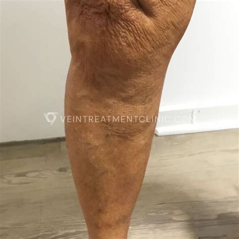 What Are Varicose Veins? | Definition, Causes & Meaning | Vein ...