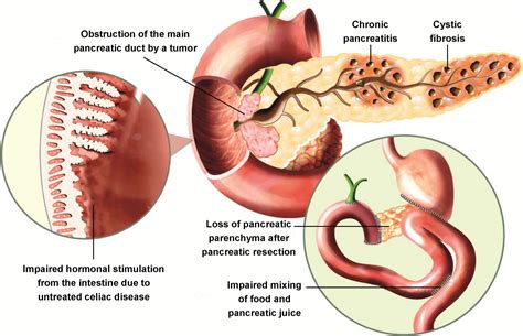 200以上 exocrine pancreatic insufficiency symptoms mayo clinic 642909