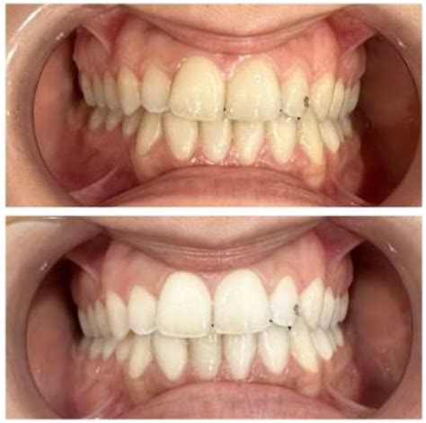 Applied Sciences | Free Full-Text | Efficacy of Carbamide and Hydrogen Peroxide Tooth Bleaching ...