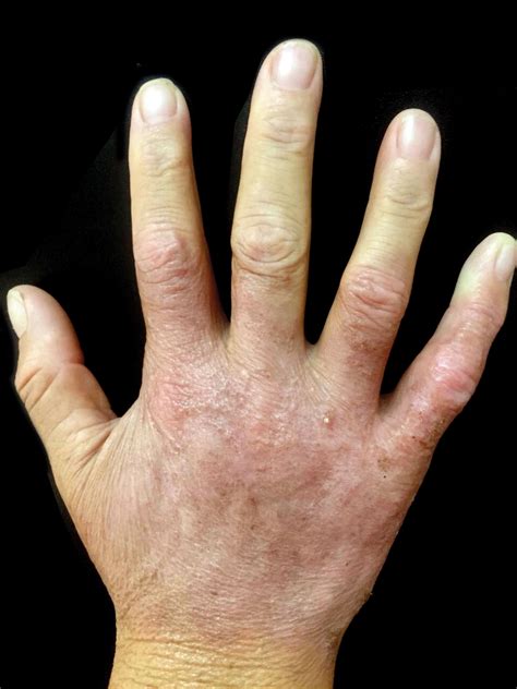 Neutrophilic dermatosis of the dorsal hands: response to dapsone monotherapy* | Anais ...