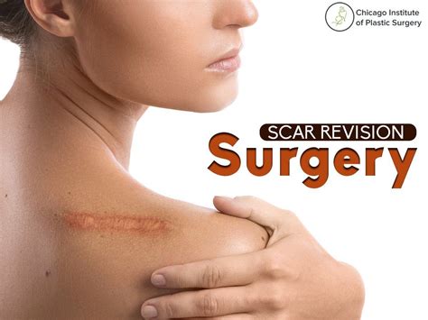 Scar Revision Surgery Ireland at Jacqueline Sadler blog