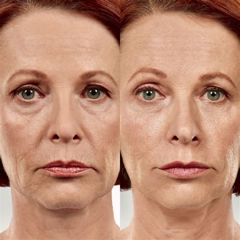 Botox before and after for lip & marionette lines! | Botox, Botox fillers, Botox before and after