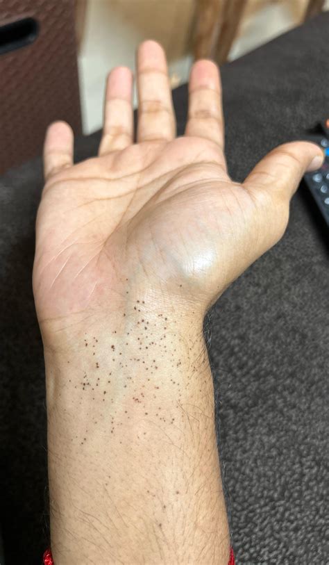 What are these small black spots on my wrist? : r/DermatologyQuestions