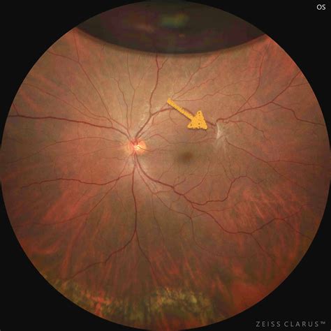 Epiretinal membrane treatment - Retina Center Tijuana