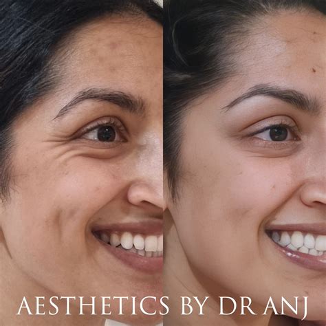 Crows Feet — Aesthetics by Dr Anj