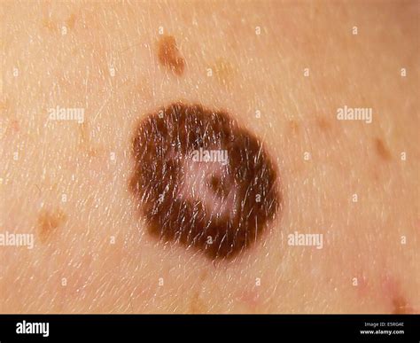 Dysplastic Nevus Of Skin