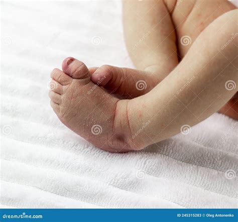Peeling of the Legs in Newborns, Caring for the Health Stock Image ...