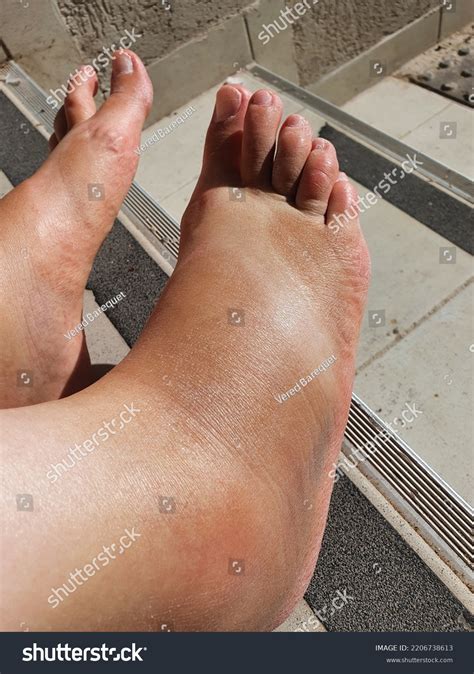 Avulsion Fracture Ankle Swelling