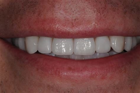 Porcelain Crowns Front Teeth