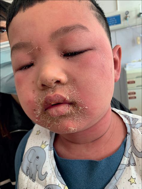Staphylococcal scalded skin syndrome in a child - The Lancet Infectious ...