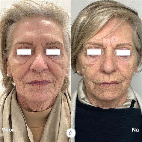 Sculptra facelift: een 100% natuurlijke huidverbetering!