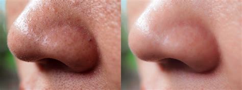 How To Clean Your Nose Pores With Natural Remedies? – Vedix