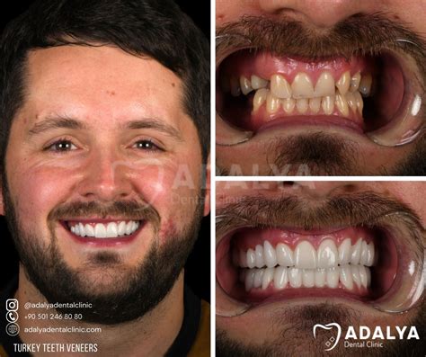 Turkey Teeth Veneers - Affordable Dental Veneer Price in Antalya