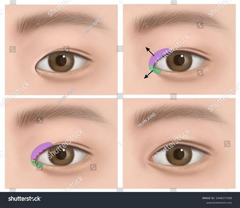 Epicanthic Fold Types Teuim Aesthetic Plastic Surgery Clinic